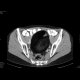 Dermoid of the ovary: CT - Computed tomography